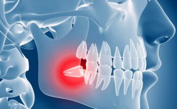 Impacted Wisdom Teeth Removal Surgery in Oxnard