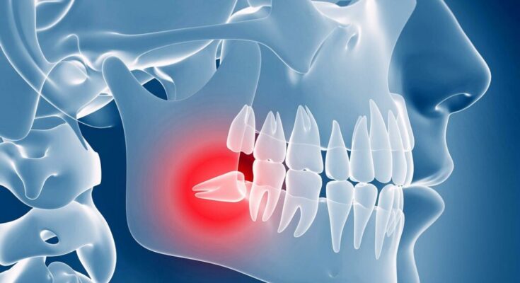 Impacted Wisdom Teeth Removal Surgery in Oxnard